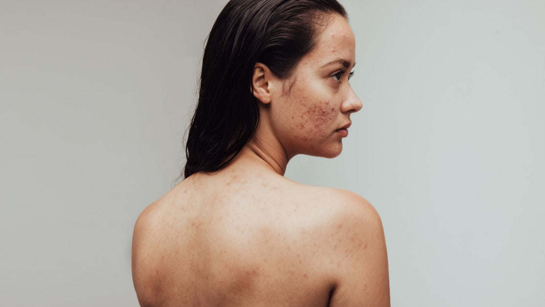 ACNE-FRIENDLY RITUALS - ACNE AWARENESS MONTH