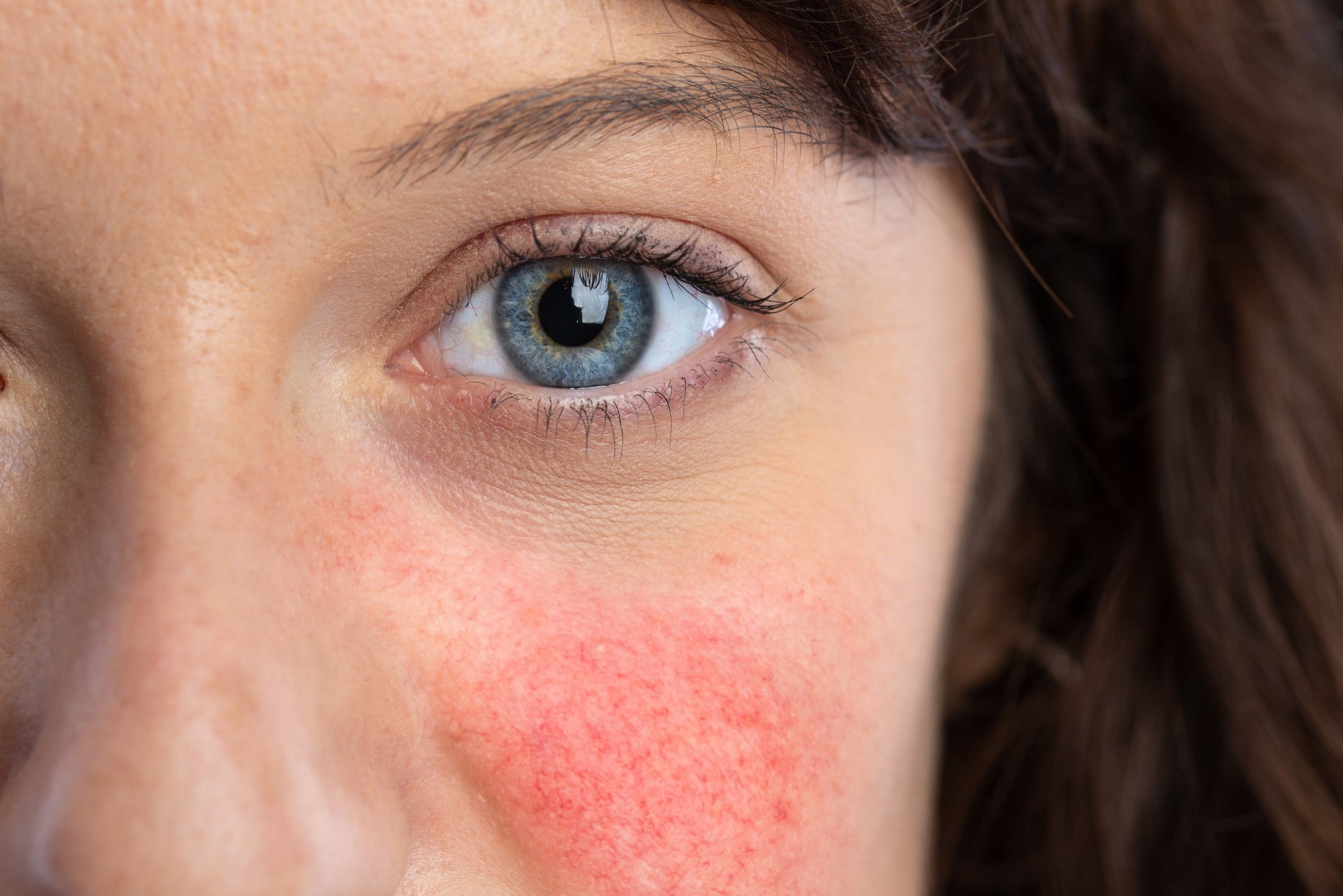 Rosacea Awareness Month - How Skincare Can Help Manage Symptoms