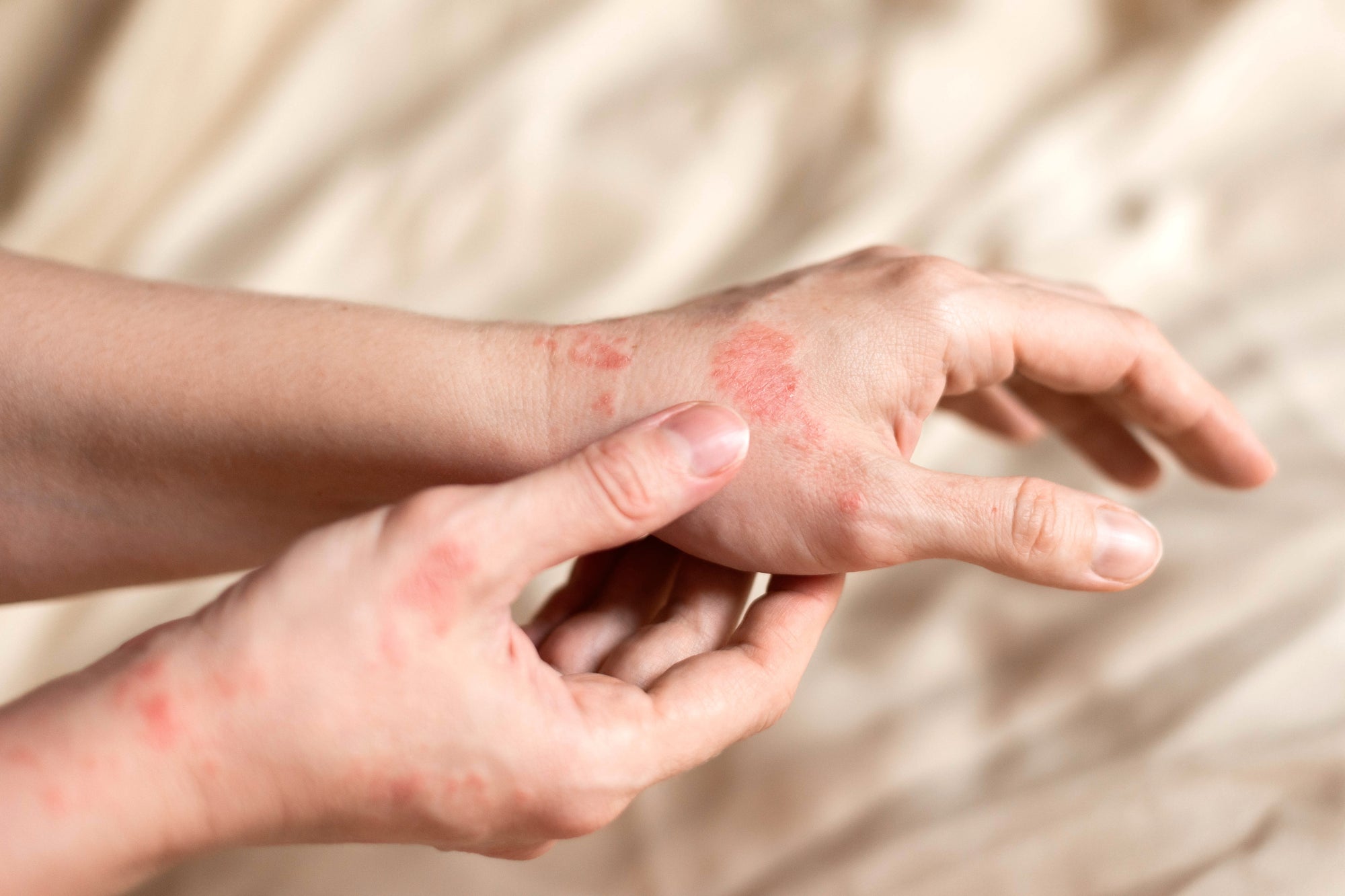 ECZEMA AWARENESS MONTH - ITCHY SKIN TIPS FROM OUR SOCIAL MEDIA WARRIORS