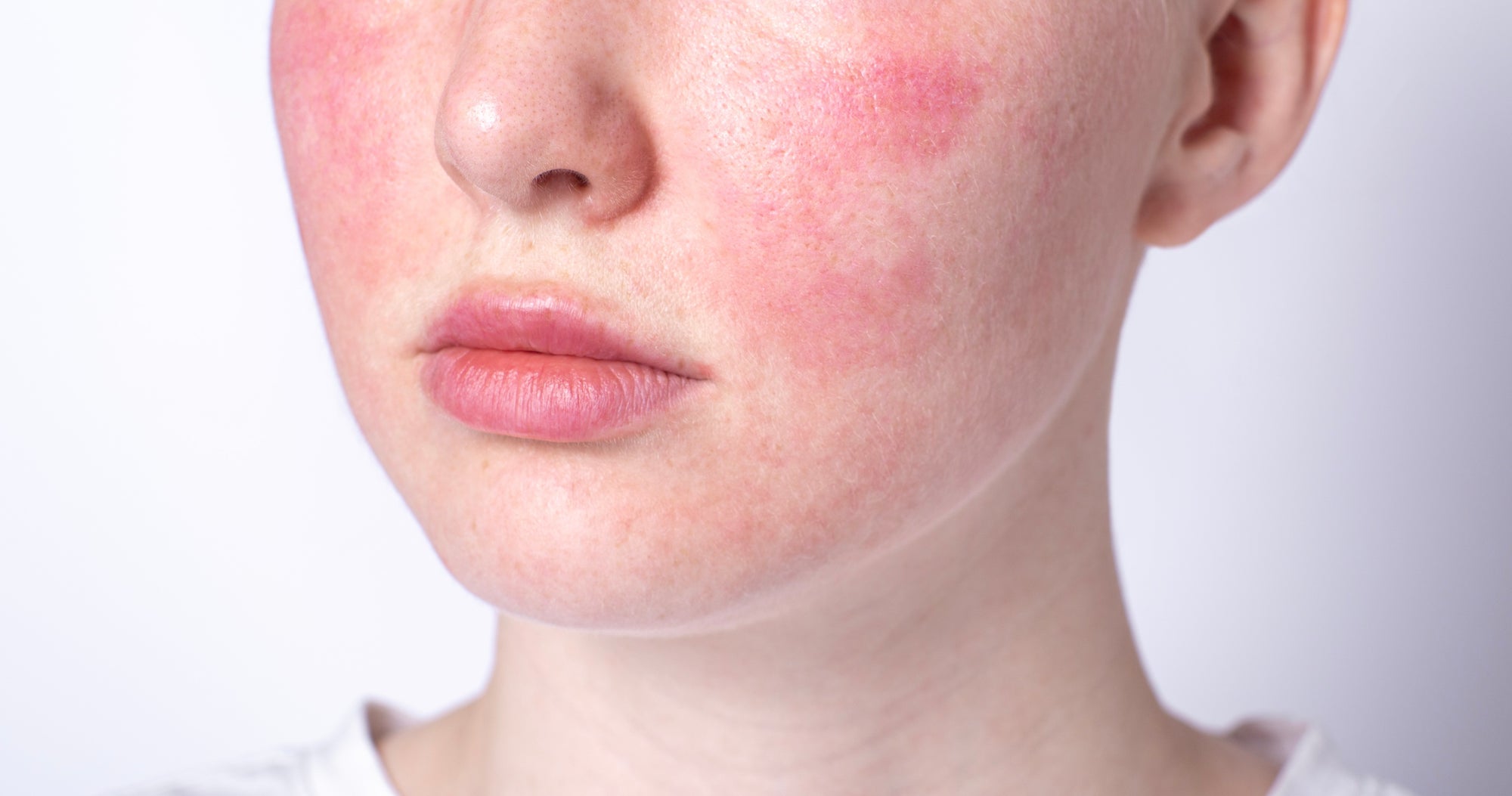 THE SENSITIVE SKIN GUIDE: WHAT, WHY & HOW TO AVOID A FLARE UP