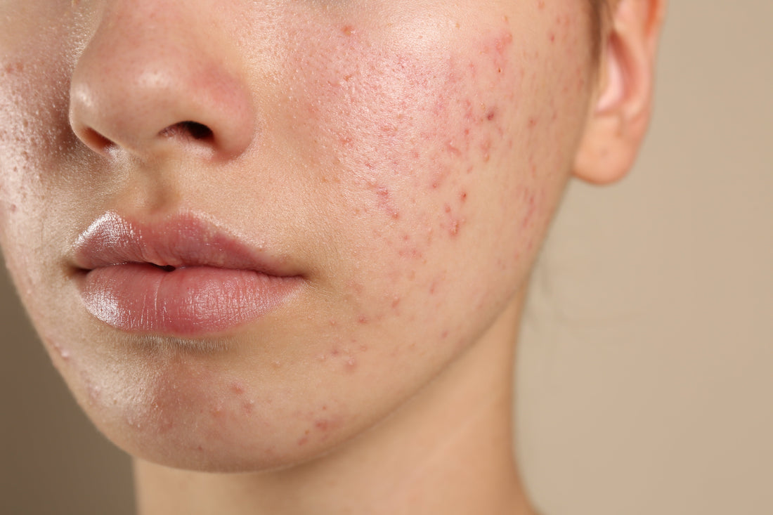 Acne Awareness Month: Real Talk on Breakouts, Red Marks &amp; Healing Skin
