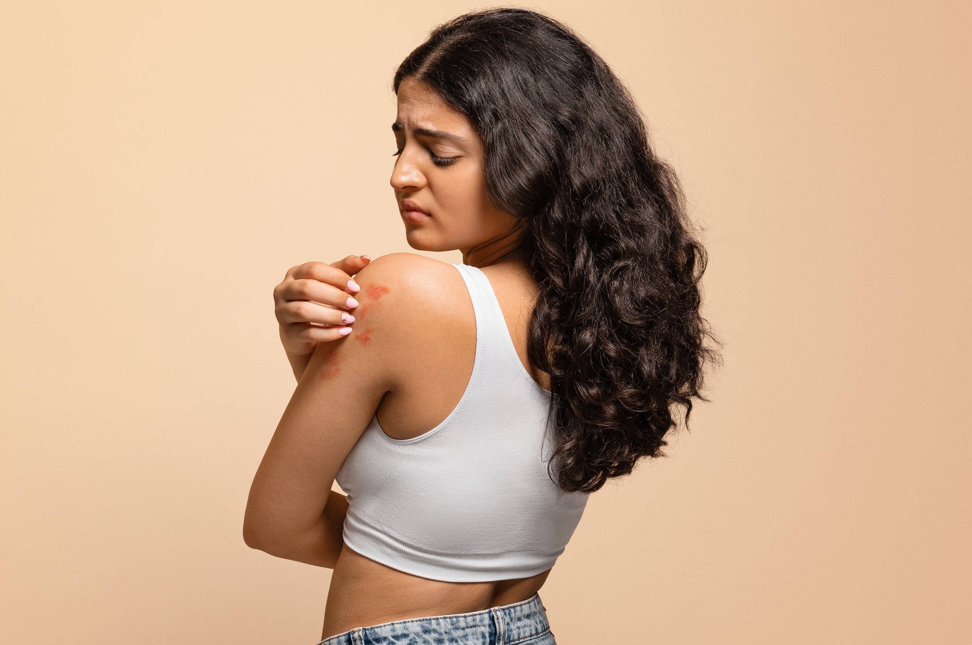 Psoriasis - Breaking the flare-up cycle
