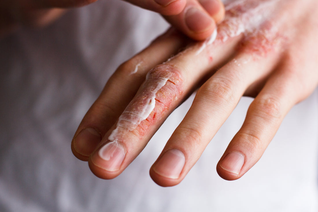WINTER SKIN ESSENTIALS - ALL YOU NEED TO KNOW TO PERFECT YOUR WINTER SKINCARE ROUTINE