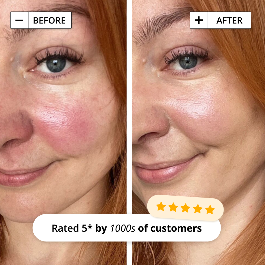 ANTI-REDNESS STARTER KIT